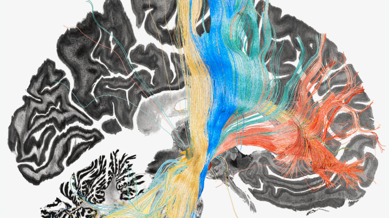 Transformation through Innovative Brain Mapping: A Breakthrough for OCD Patients