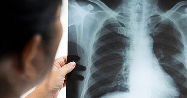 Ung thư phổi: Những Bài Học Đắt Giá từ Gia Đình Đồng Mắc Bệnh