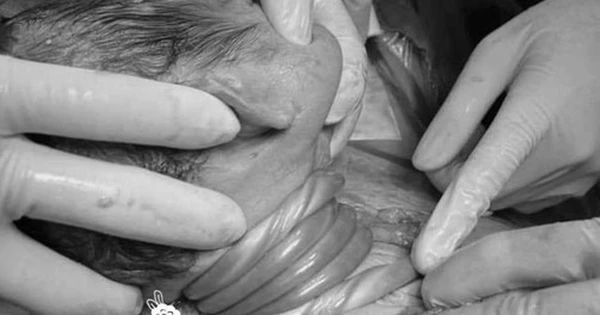 Hiểm họa của Dây Rốn Quấn Cổ Thai Nhi: Những Điều Bạn Cần Biết