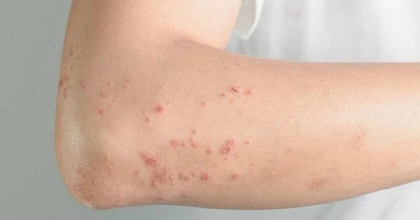 Sởi - Bệnh truyền nhiễm cấp tính đáng lo ngại