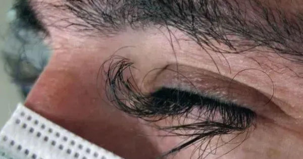 Bí ẩn lông mi mọc dài sau điều trị ung thư: Tác động kỳ lạ của thuốc