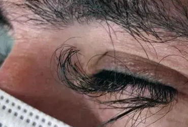 Bí ẩn lông mi mọc dài sau điều trị ung thư: Tác động kỳ lạ của thuốc