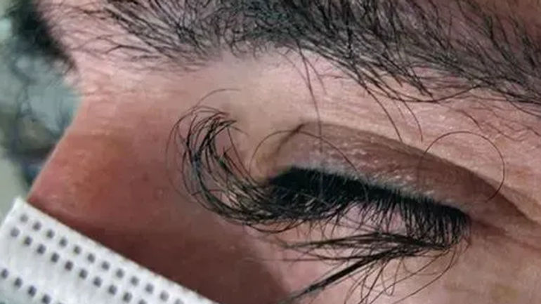 Bí ẩn lông mi mọc dài sau điều trị ung thư: Tác động kỳ lạ của thuốc