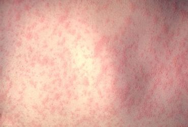 Worldwide Measles Cases See Sharp Increase in One Year, Study Shows