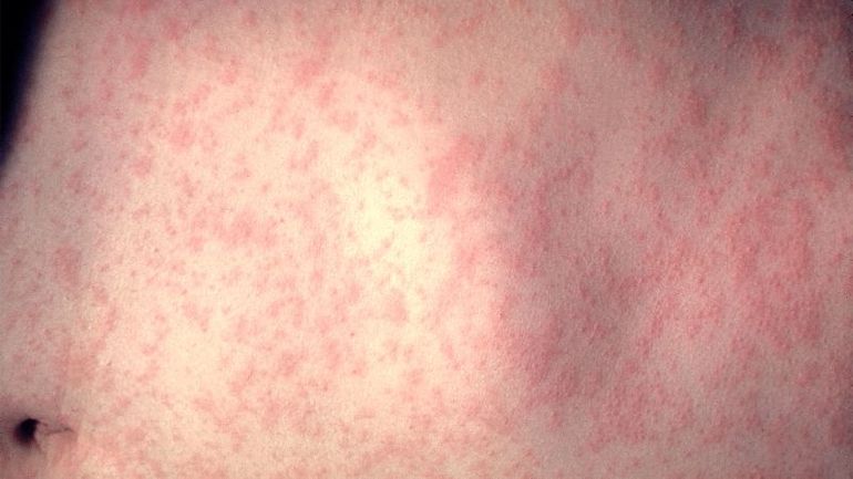 Worldwide Measles Cases See Sharp Increase in One Year, Study Shows