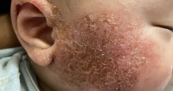 Bí quyết chăm sóc da cho trẻ sơ sinh: Đừng tự tắm lá thuốc tại nhà