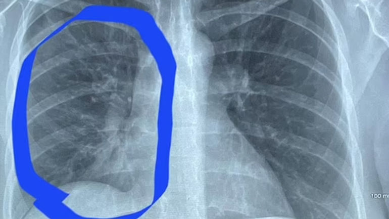 Những Bài Học Đắt Giá Từ Câu Chuyện Của Cô Gái 30 Tuổi Với Phổi Trắng Bất Thường