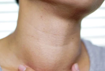 Bướu Tuyến Giáp: Hành Trình Từ Lành Tính Đến Ung Thư