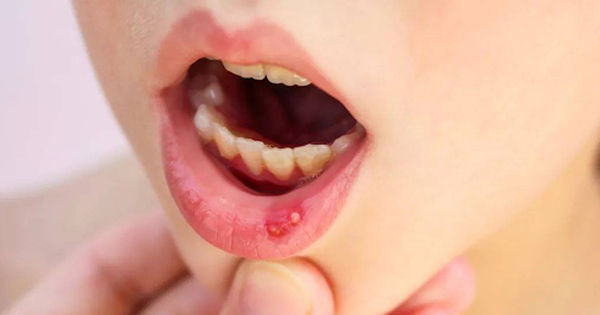 Bí mật ẩn sau nụ cười: Những dấu hiệu răng miệng cảnh báo ung thư