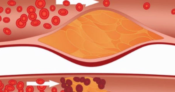 Khám phá bí mật: 3 dấu hiệu tiên tri tắc nghẽn mạch máu