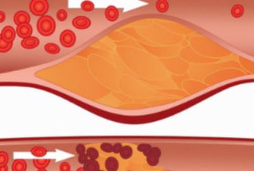 Khám phá bí mật: 3 dấu hiệu tiên tri tắc nghẽn mạch máu