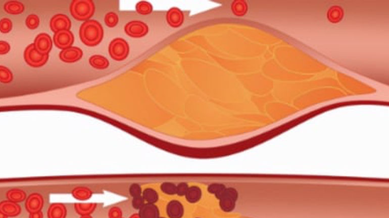 Khám phá bí mật: 3 dấu hiệu tiên tri tắc nghẽn mạch máu
