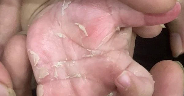 10 biểu hiện không thể tin được khi bé trai 3 tháng tuổi mắc bệnh giang mai