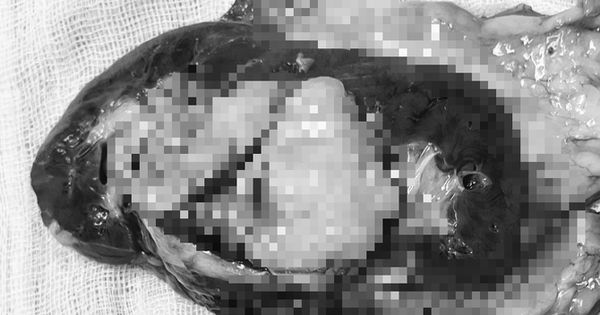 Kỷ lục mới: Thành công lần đầu tiên phẫu thuật hiếm gặp tại Việt Nam