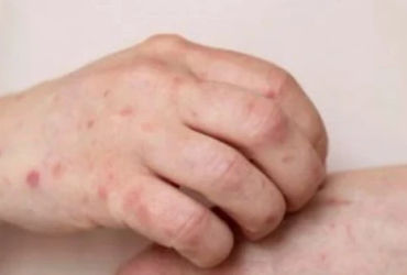 TPHCM ghi nhận ca nhiễm bệnh đậu mùa khỉ kỷ lục, nguy cơ lan tỏa cực cao