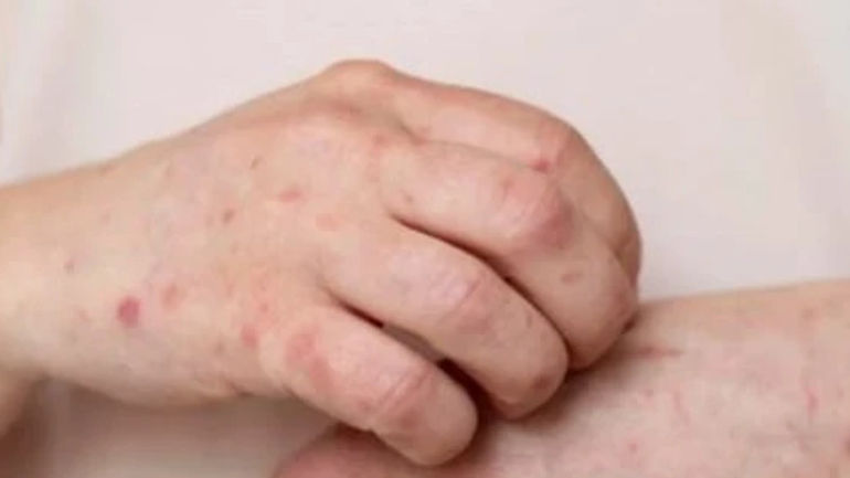 TPHCM ghi nhận ca nhiễm bệnh đậu mùa khỉ kỷ lục, nguy cơ lan tỏa cực cao