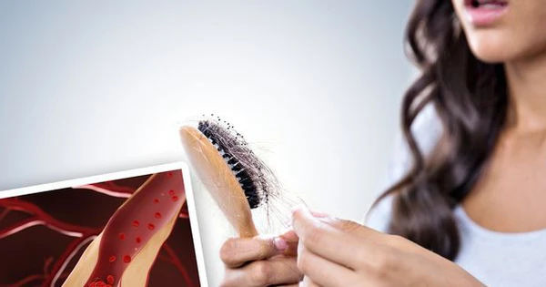 Dấu hiệu sốc trên tóc mà bạn không ngờ đến - cơ hội tiềm ẩn về cholesterol cao