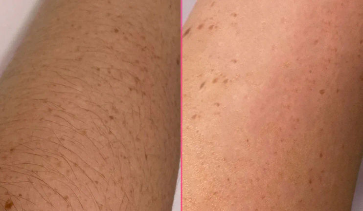 Revolutionary Hair Removal Devices: Unveiling the Ultimate Gems Under $400