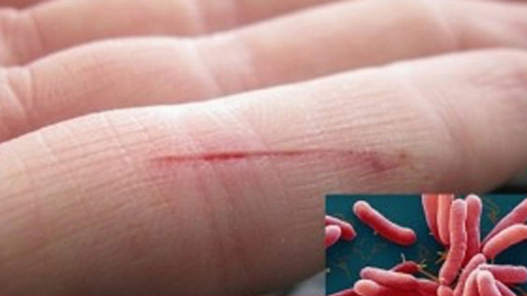 Dịch nhiễm vi khuẩn 'ăn thịt người' gây tử vong: Sở Y tế Quảng Nam hành động kịp thời