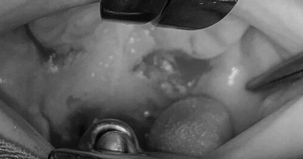 Bé trai ngậm que gỗ bị đâm thủng vòm hầu khi chạy