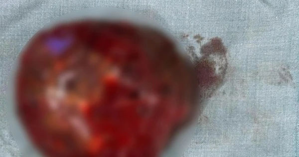 Bé sơ sinh bị bướu máu gan khổng lồ