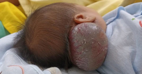 Cắt khối u máu hiếm gặp cho bé sơ sinh