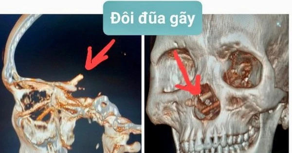 Đôi đũa nằm câm trong hộp sọ 5 tháng không được phát hiện