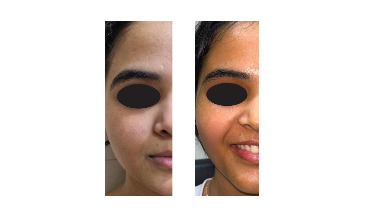 Facial Slimming & Contouring