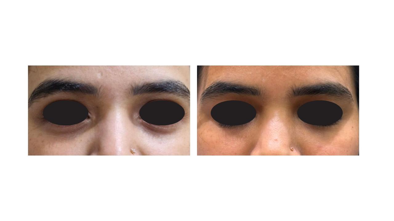 Restoring Under-Eye Volume & Harmony