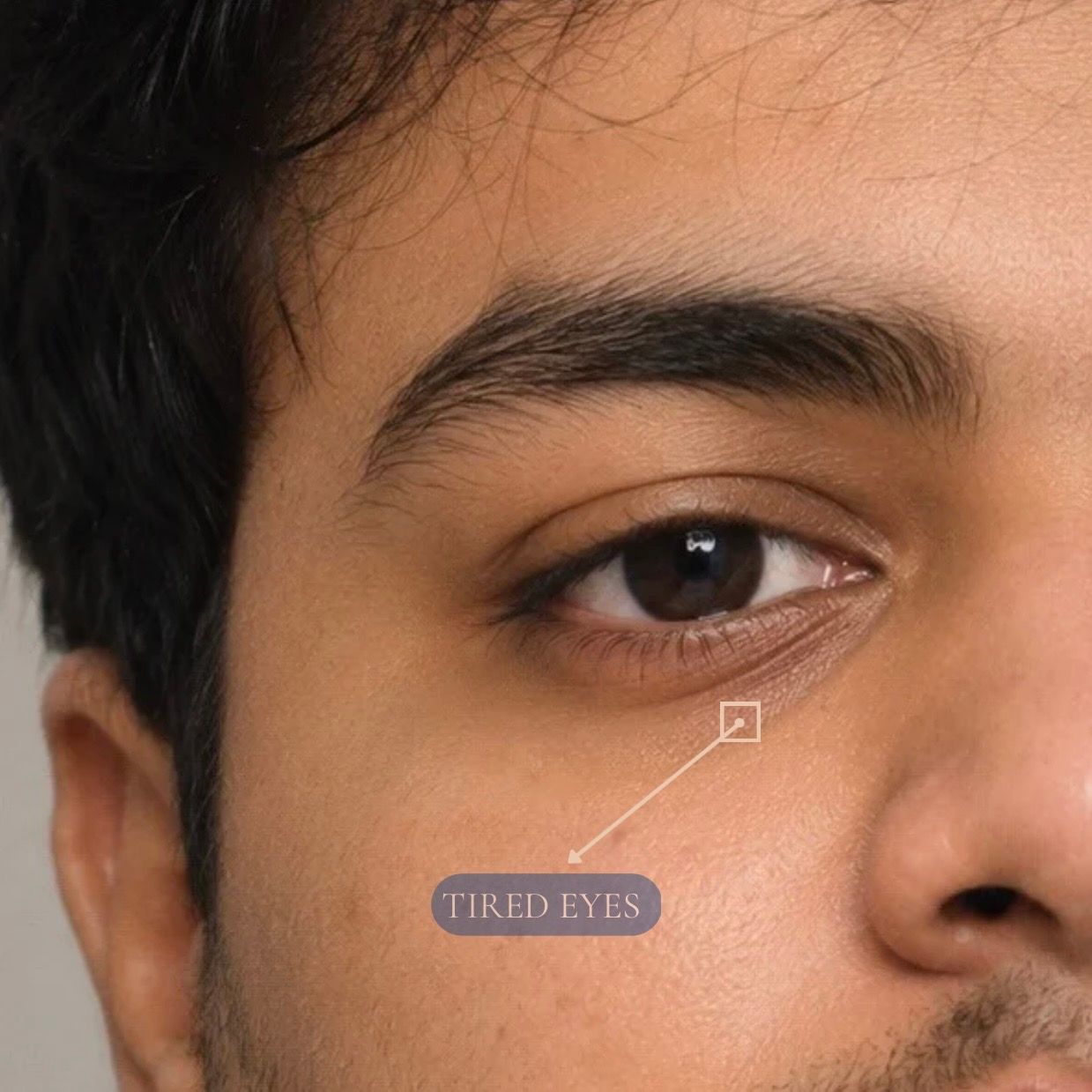 Under Eye Filler