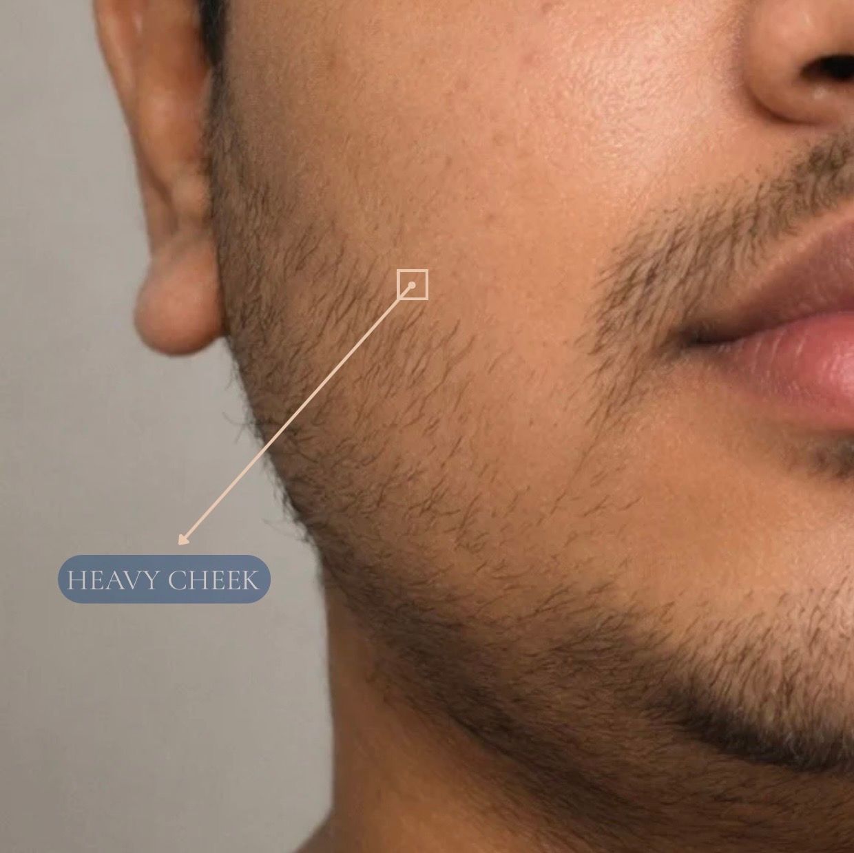 Buccal Fat Reduction