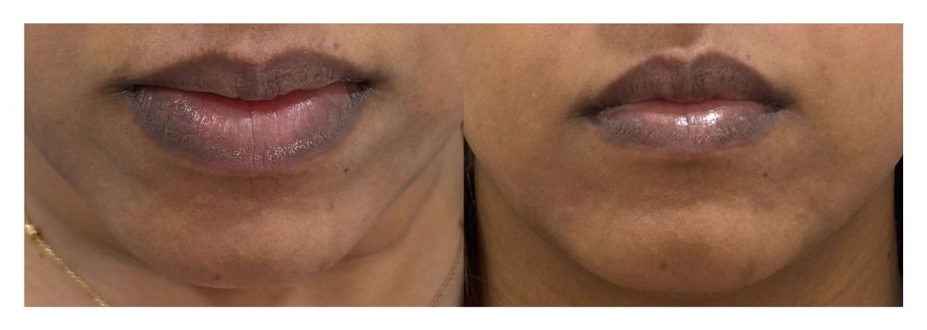 Lower Face Harmony with Dermal Fillers