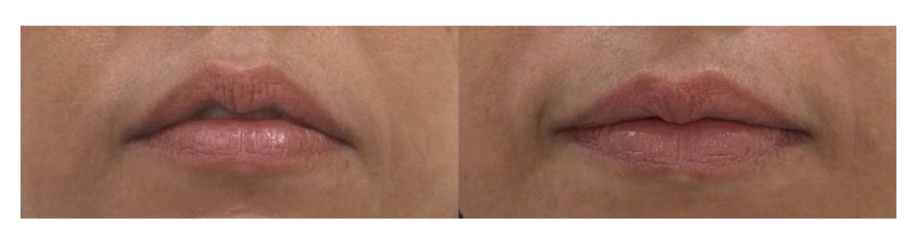 Lip Fillers – Keeping It Natural