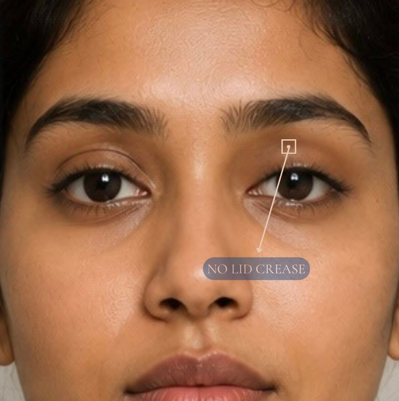 Ptosis Correction