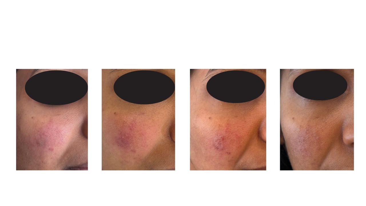 Filler Complication Management