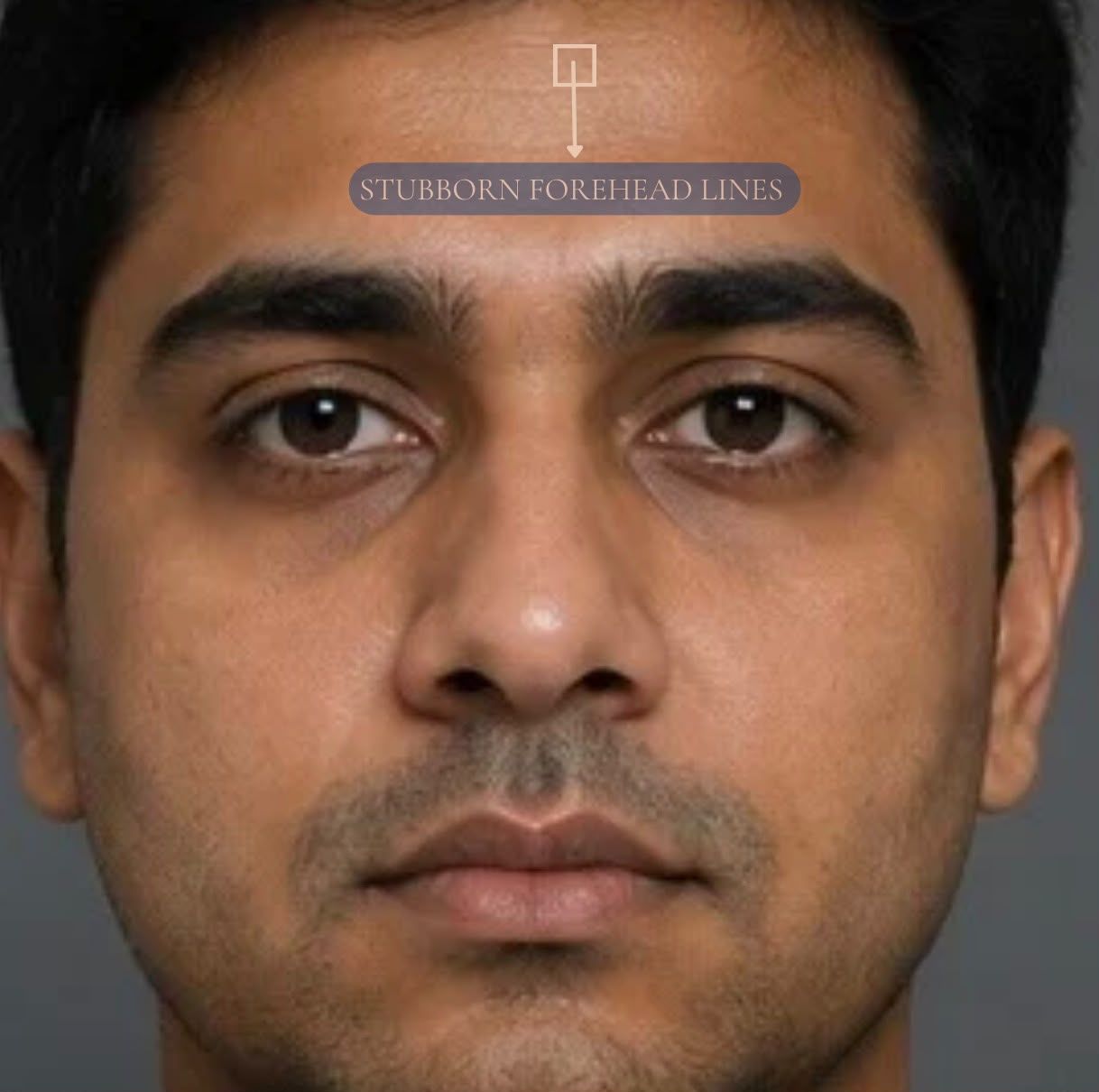 Forehead Lift
