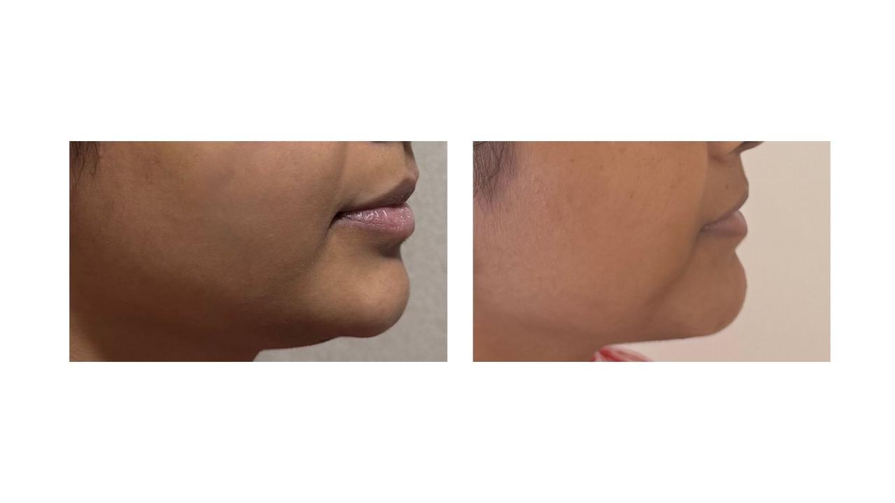 Define Your Chin, Refine Your Jawline