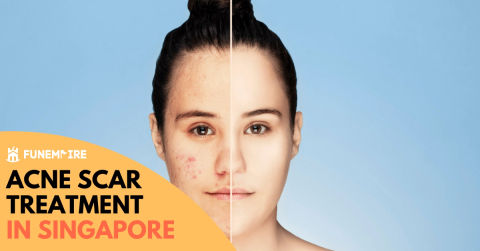 Acne Scar Treatment Singapore