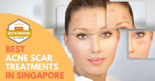 Best Acne Scar Treatment Singapore