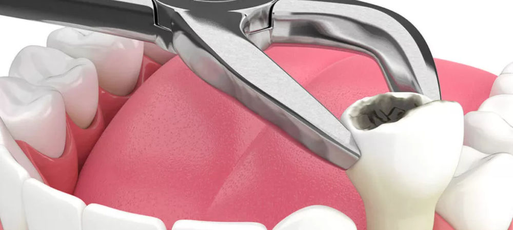 Dental Care Tips