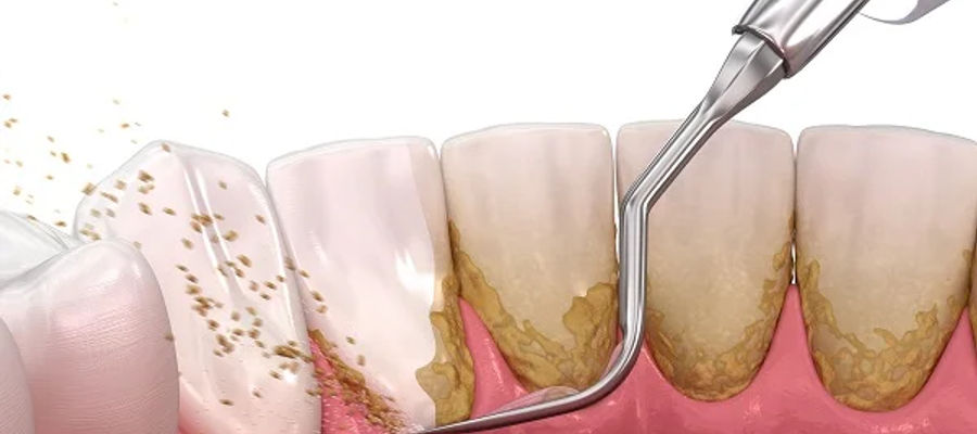 Why regular dental checkups?