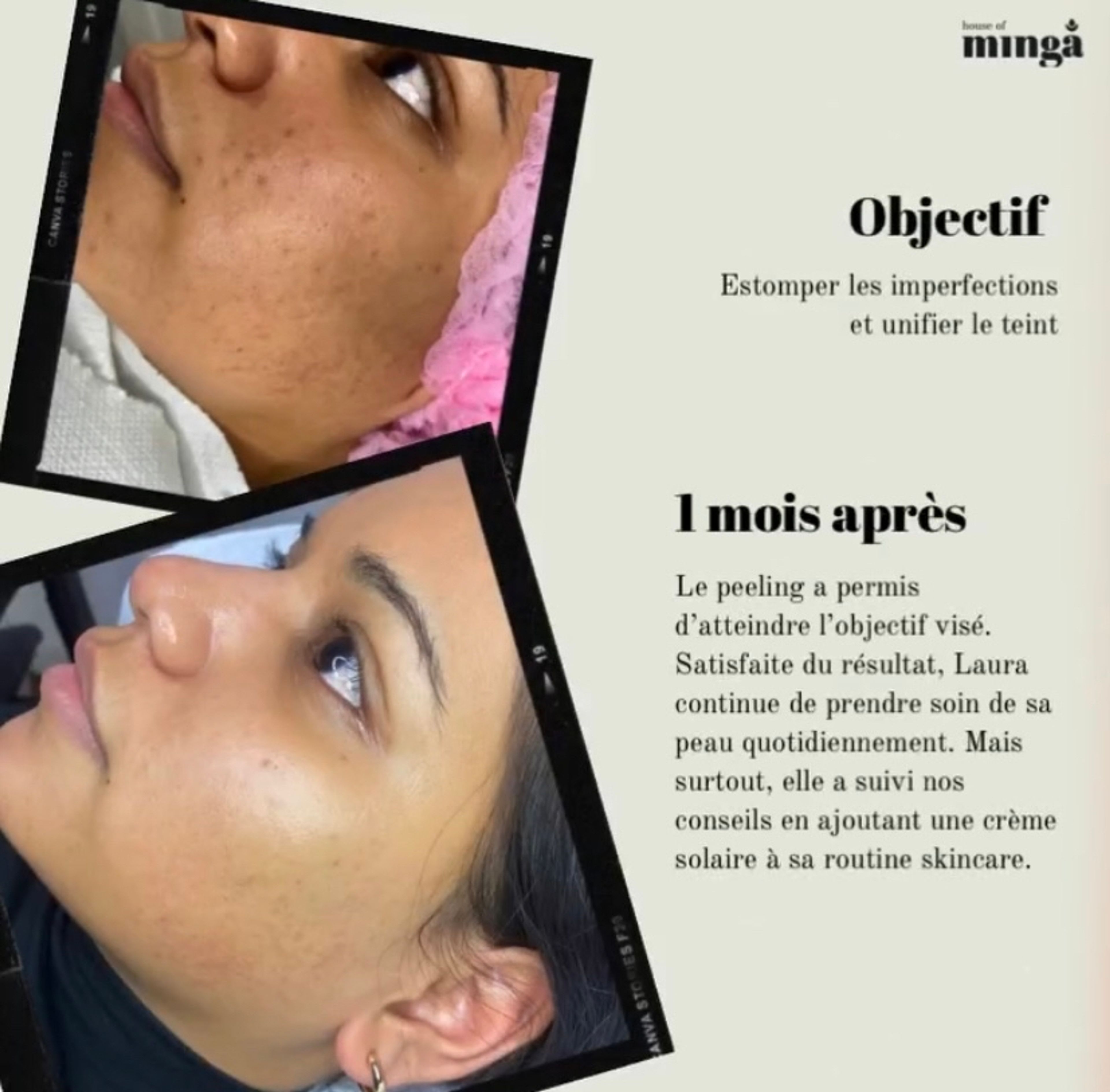 Peeling Visage ou Petite zone (mains, aisselles…)