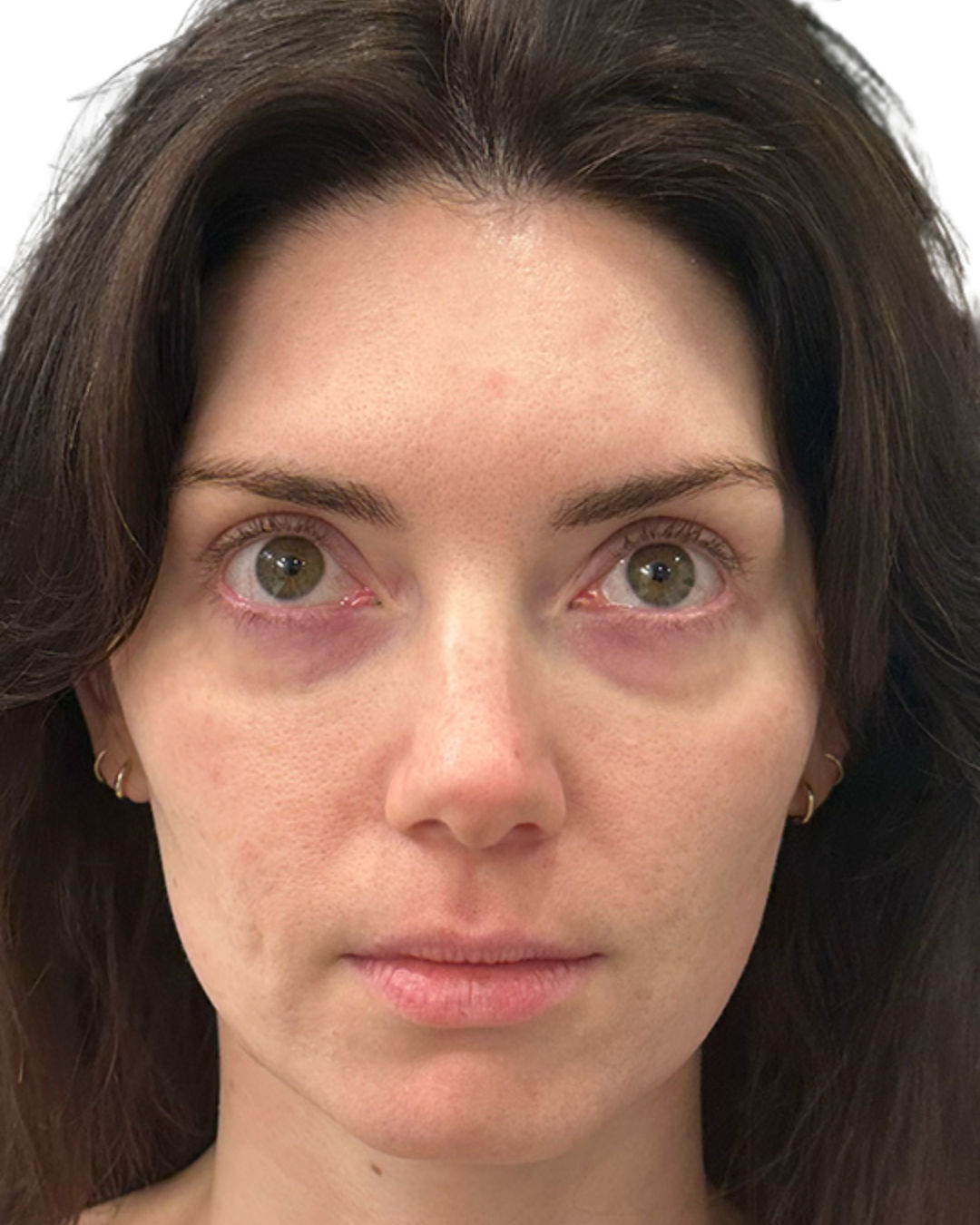 After treatment