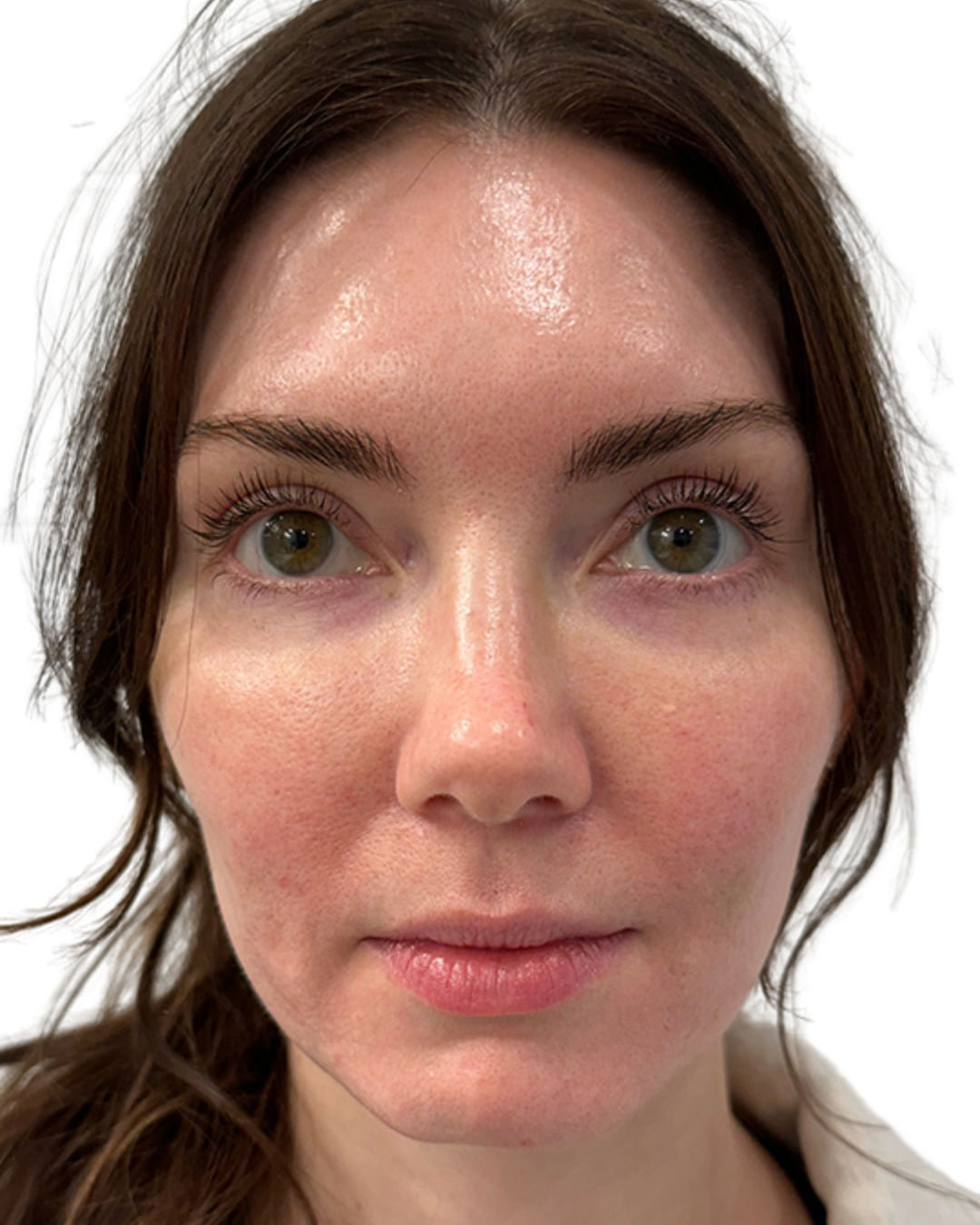 Before treatment