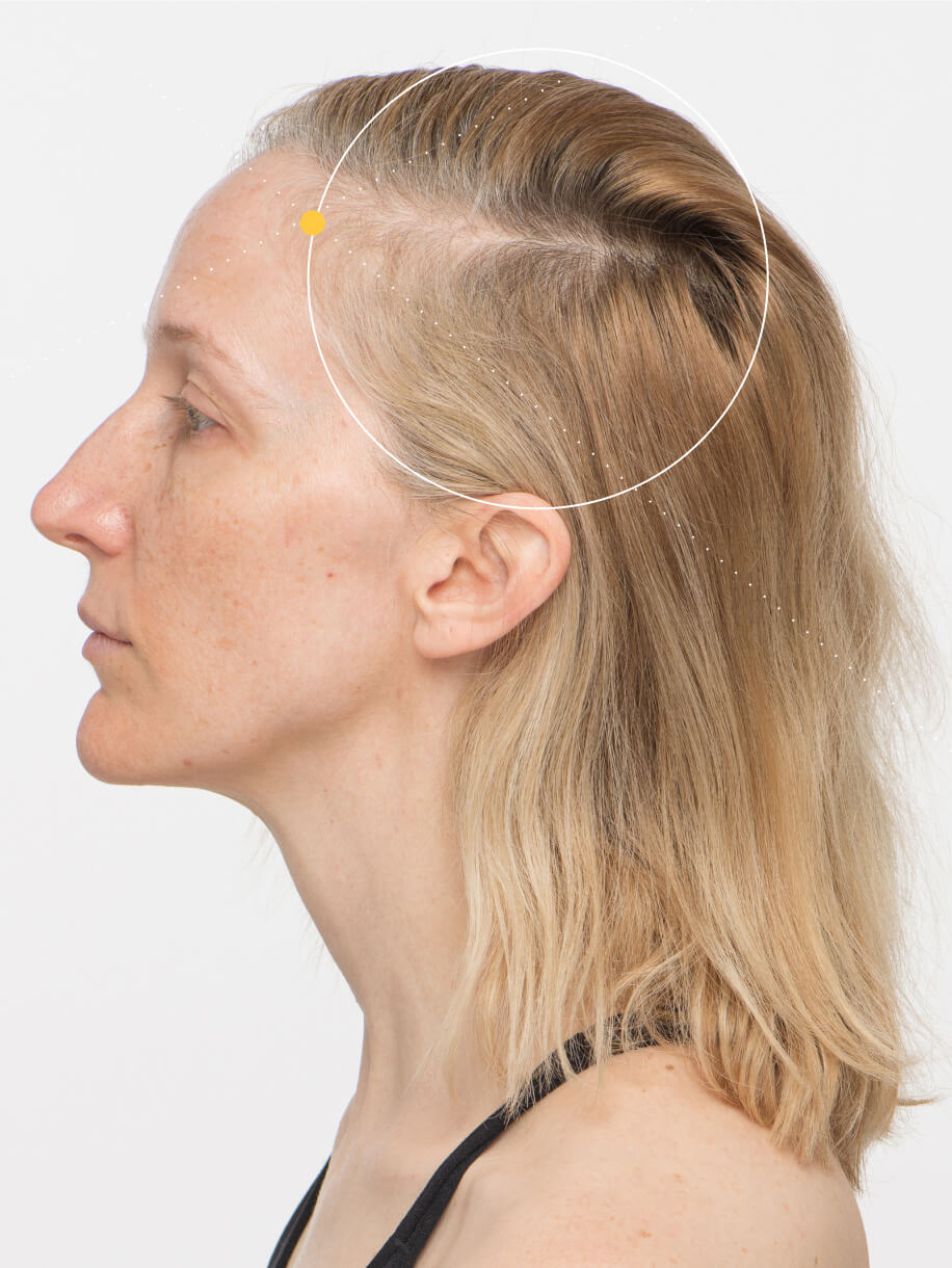 Tanya before taking Nutrafol Women’s Vegan Hair Growth Nutraceutical.