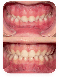 Patient 5 years old — before and 1 year in