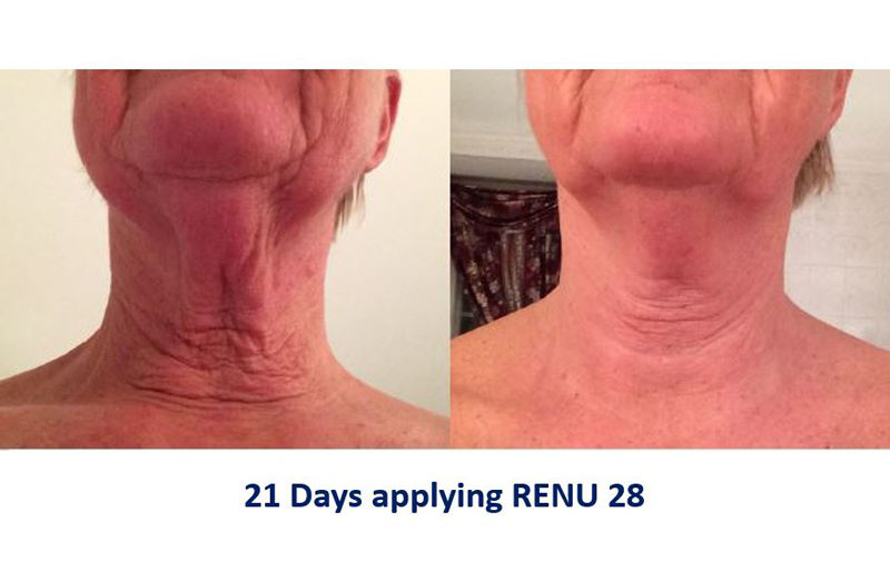 RENU 28 GEL - Discover Redox