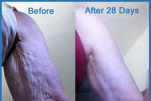 Award Winning RENU28 Results After 28 Days