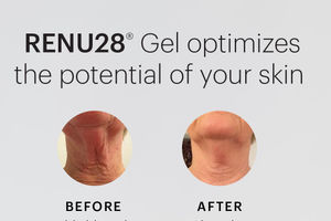 RENU28 Gel Optimizes the Potential of Your Skin