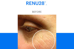 What RENU28 helps with